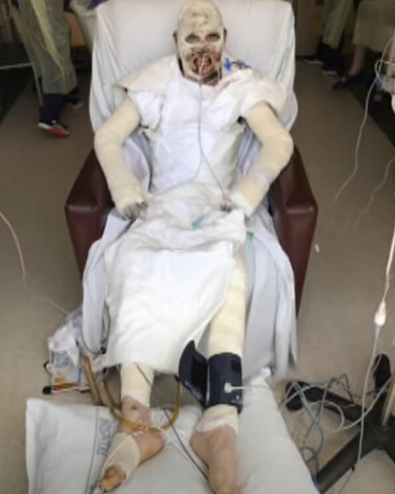 Chang trai song sot sau vu nui lua phun trao, bong 80% co the hinh anh 1 28242010_8306147_image_a_24_1589163874790_Copy.jpg