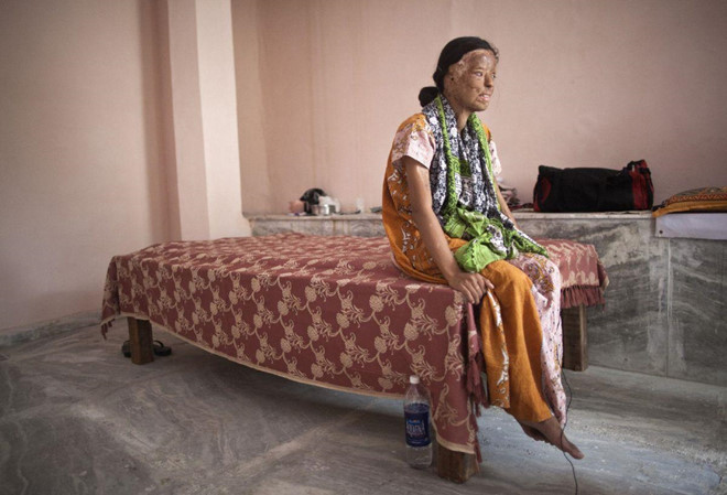 Co gai bi tat axit tham gia 'Ai la trieu phu' de kiem tien dieu tri hinh anh 2